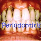periodoncia periodontitis