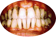 periodontitis enfermedad periodontal piorrea