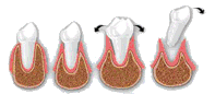 periodontitis enfermedad periodontal evolucion piorrea