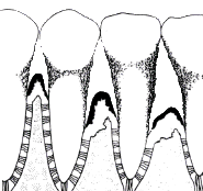 periodontitis enfermedad periodontal evolucion piorrea
