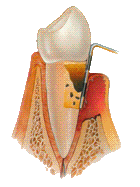 periodontitis enfermedad periodontal tratamiento piorrea